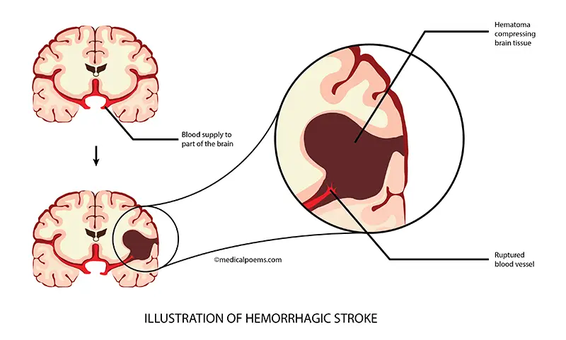 Hemorrhagic Stroke illustration