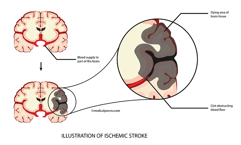 Ischemic Stroke Illustration