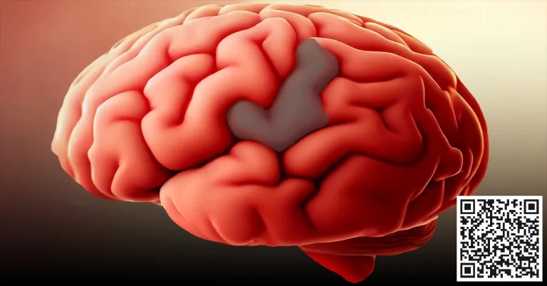 Stroke: A human brain showing an area of infarction